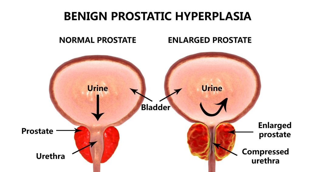 Enlarged Prostate