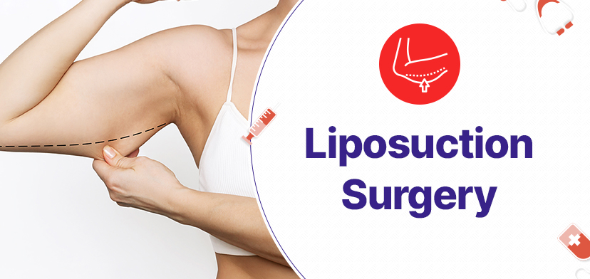 Liposuction Surgery In New Delhi: Is It The Right Choice For You?