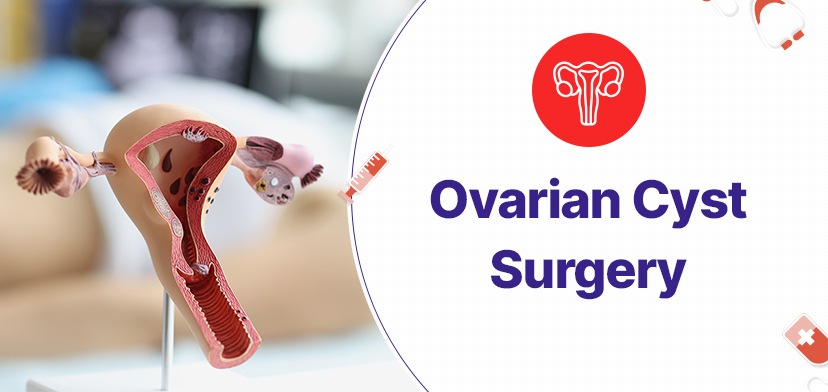 An In-Depth Look At Ovarian Cyst Surgery